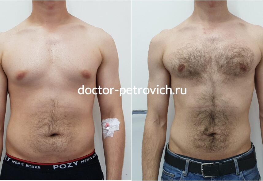 1 стадия гинекомастии фото 2 до и после