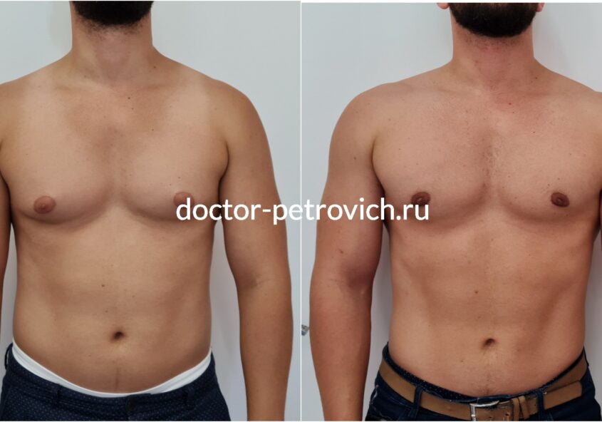 1 стадия гинекомастии фото до и после