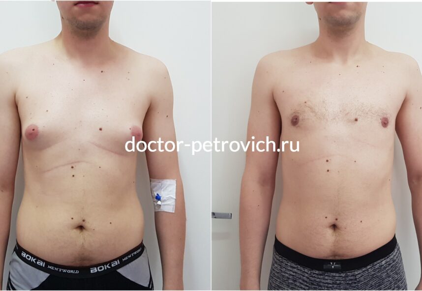 2 стадия гинекомастии фото 2 до и после
