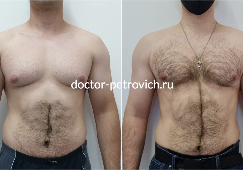 2 стадия гинекомастии фото до и после