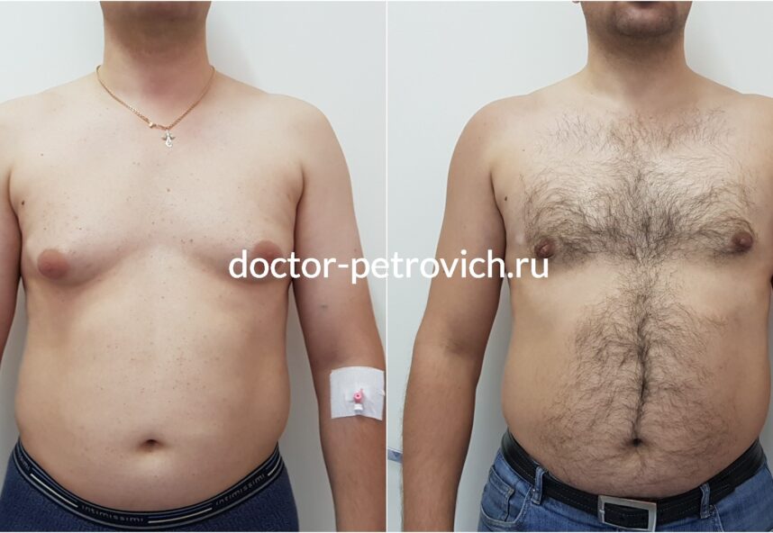 3 стадия гинекомастии фото 2 до и после