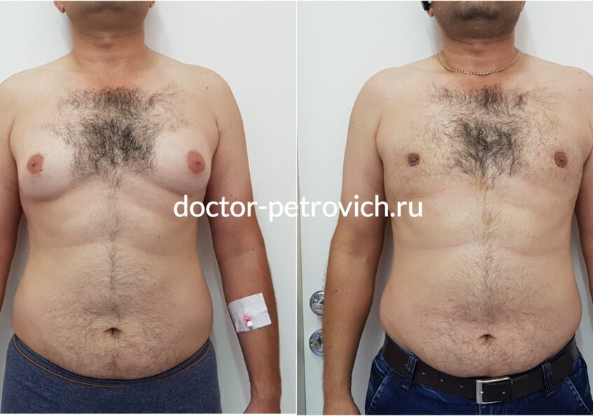 3 стадия гинекомастии фото до и после