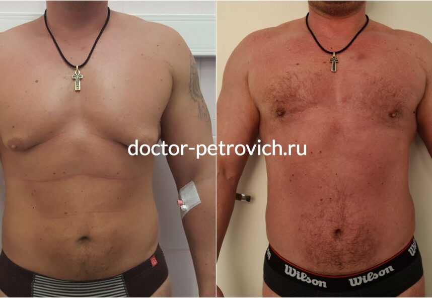 4 стадия гинекомастии фото 2 до и после