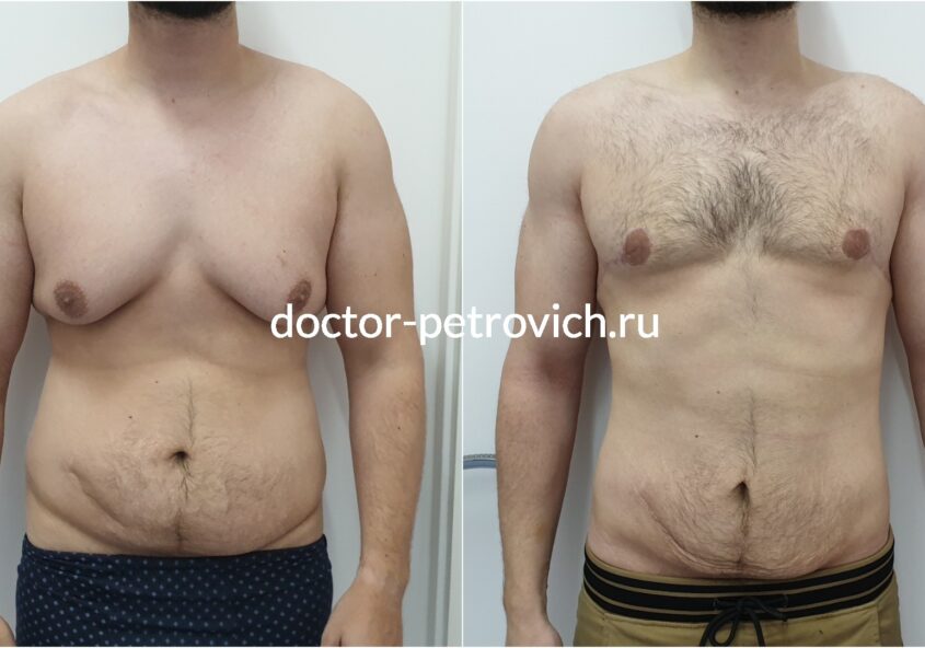 4 стадия гинекомастии фото до и после