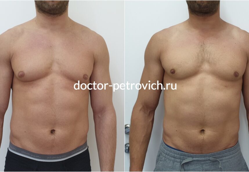 Бодибилдер гинекомастия фото 2 до и после