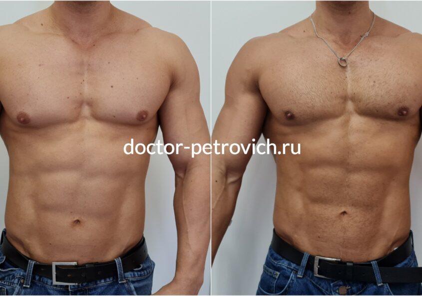 Бодибилдер гинекомастия фото до и после